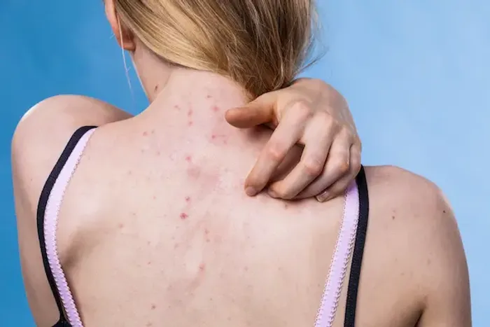 Your Complete Guide to Back Acne: Causes, Treatments, and Prevention
