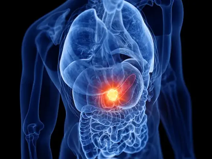 Pancreatic Cancer Symptoms