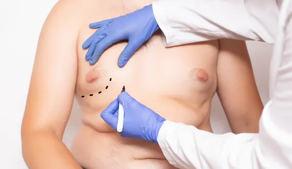 gynecomastia