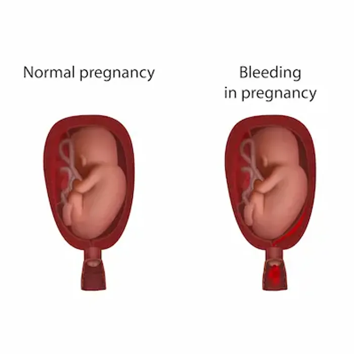 Bleeding During Pregnancy: Causes, Risks, and When to Seek Help