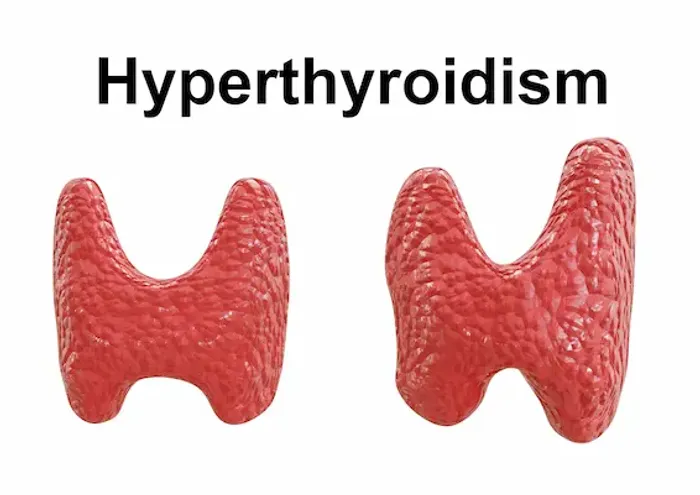 Hyperthyroidism Symptoms in Female