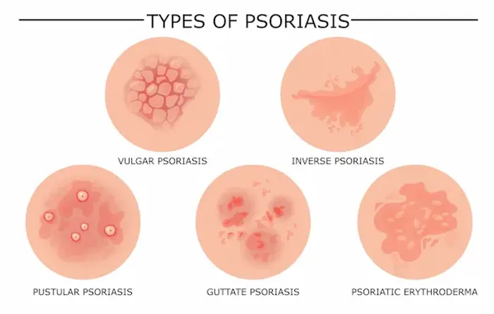 Different Types of Psoriasis