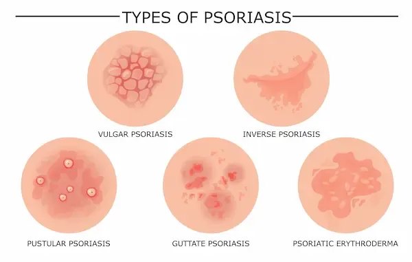 Different Types of Psoriasis