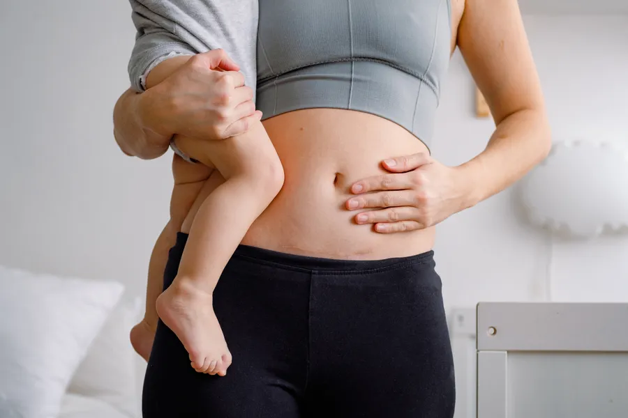 How to Reduce Tummy After C-Section?