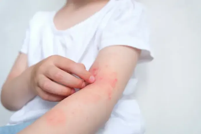 Psoriasis in Children: Causes, Symptoms And Treatment Options