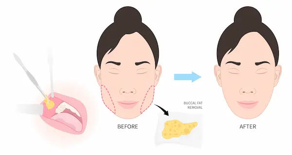 How to Reduce Buccal Fat