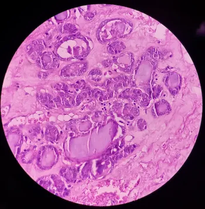 Thyroid Colloid Cyst: A Detailed Overview