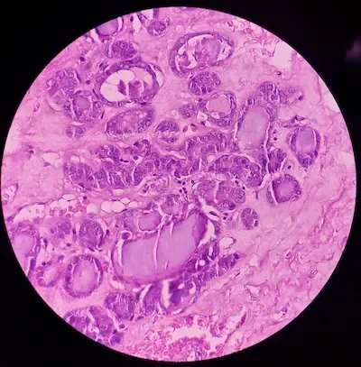 Thyroid Colloid Cyst: A Detailed Overview