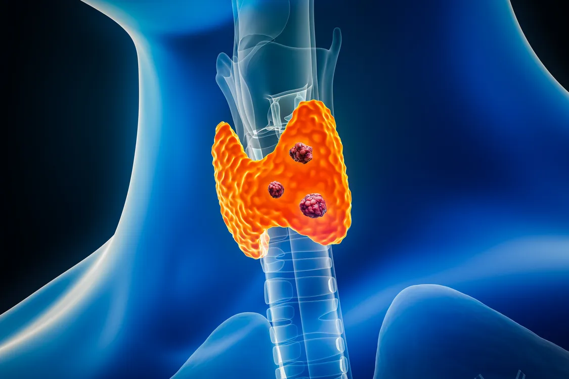 Thyroid Cancer: Symptoms, Diagnosis and Treatment Options