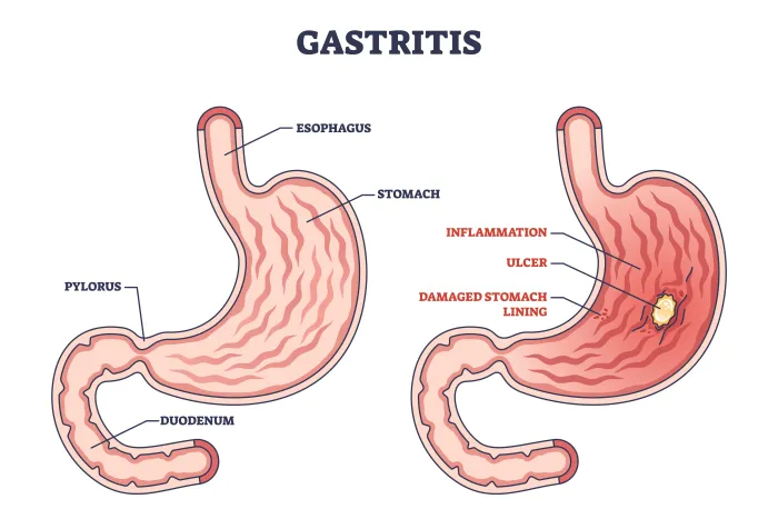 What Causes Gastritis