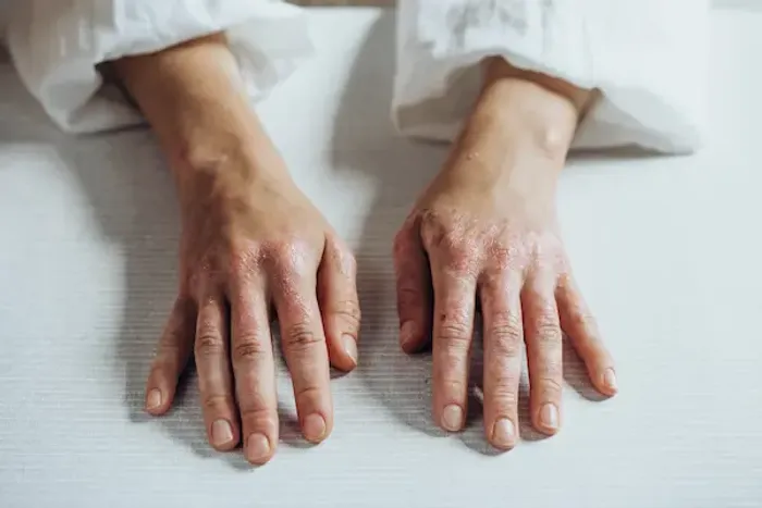 How To Cure Psoriasis Permanently?