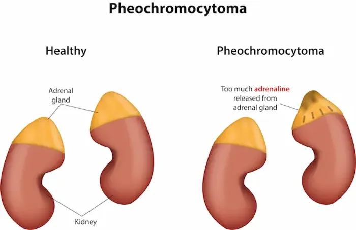 Pheochromocytoma and High Blood Pressure