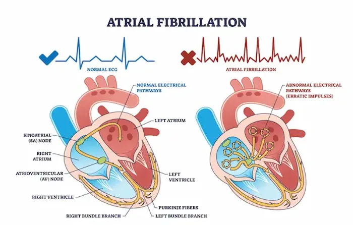 Atrial Fibrillation: Causes, Types, Symptoms, Diagnosis, and Treatment