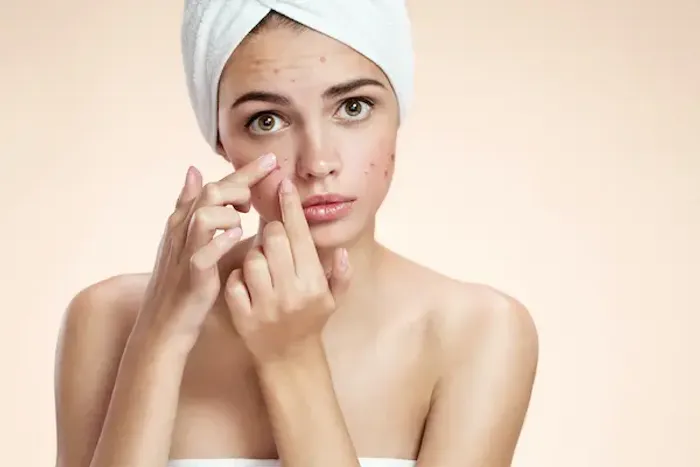 Azithromycin for Acne