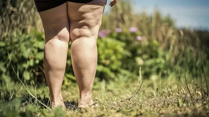 lipedema