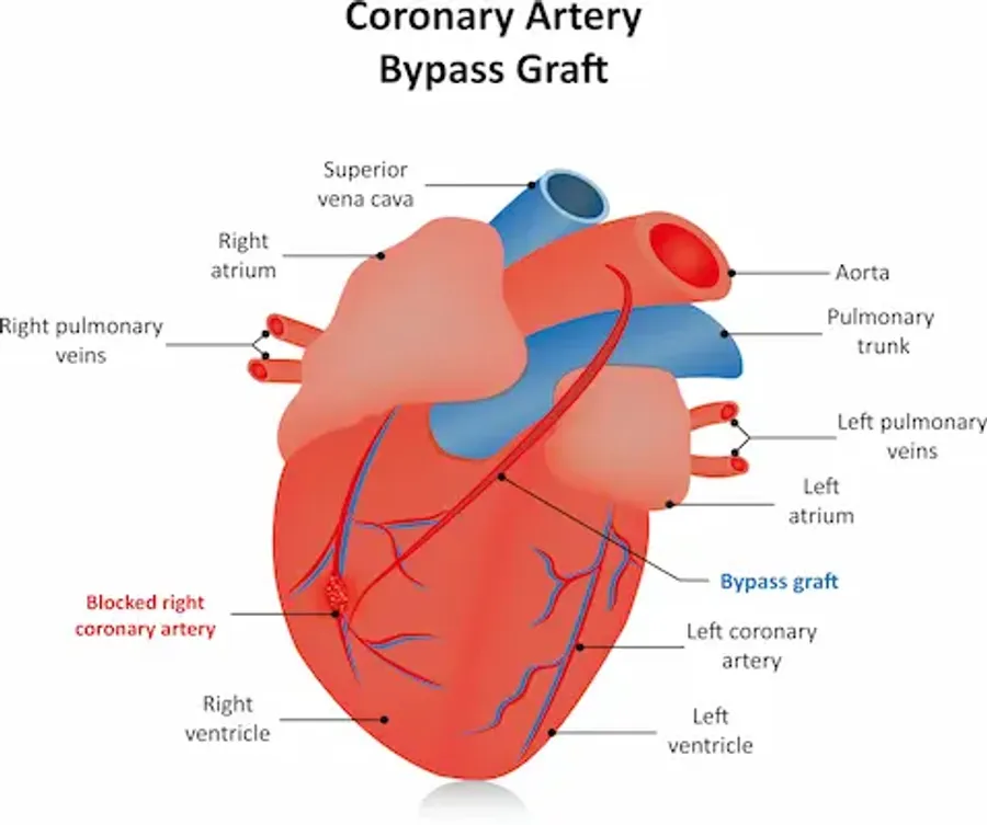 CABG Surgery: Everything You Need to Know!