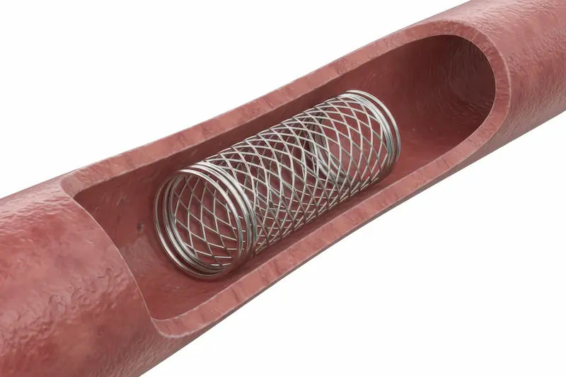 After Angioplasty: Know All About It