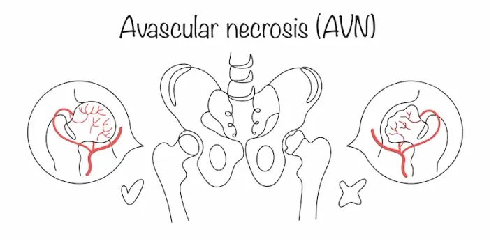 Avascular Necrosis: Causes & Treatment