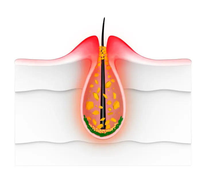 Blocked Hair Follicles: Causes, Symptoms, and Treatment
