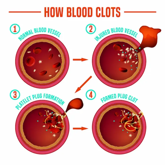 Blood Clots: Causes, Types And Treatment Of Blood Clots