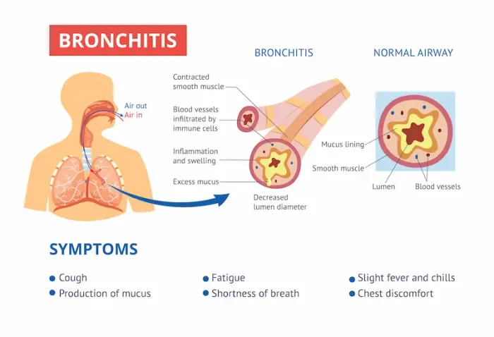 Bronchitis Symptoms