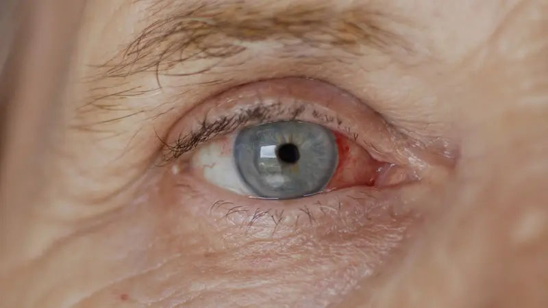 Can You Smoke Cigarettes Before Cataract Surgery?
