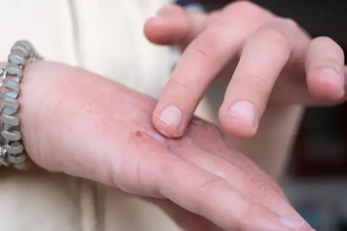 Contact Dermatitis: Causes, Risk Factors, Symptoms and Treatment