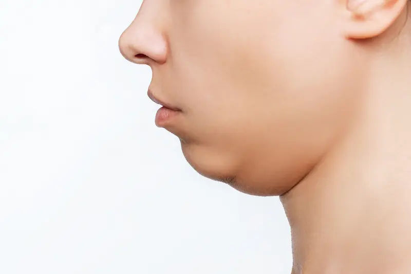 can i take glutathione while taking isotretinoin When Accutane (isotretinoin) your skin tends to be more sensitive and there be impaired wound healing as well. Hair removal, especially waxing, can be damaging to the skin as it removes the Maximizing Accutane Results with Dietary