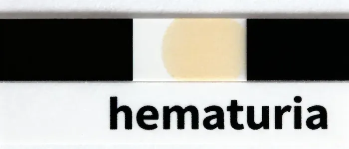 Hematuria Diagnosis & Prevention