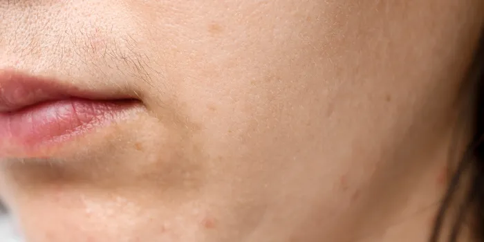 Hirsutism: Causes And Treatment