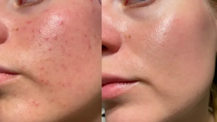 How To Reduce Pores?