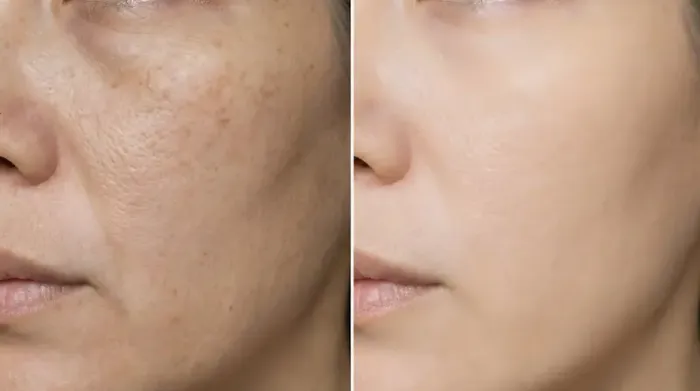 How To Reduce Skin Pigmentation?
