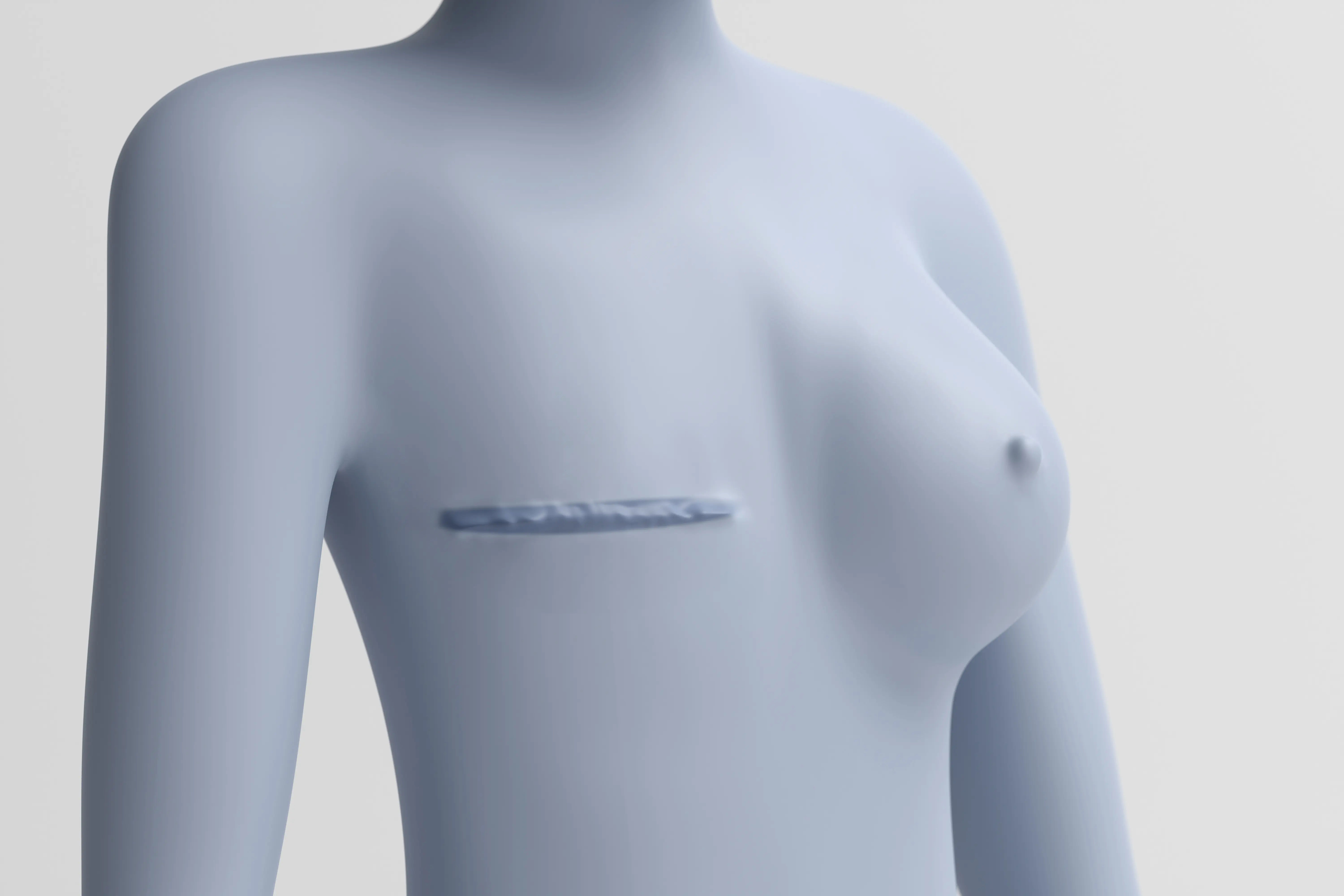 Delayed Breast Reconstruction After Mastectomy
