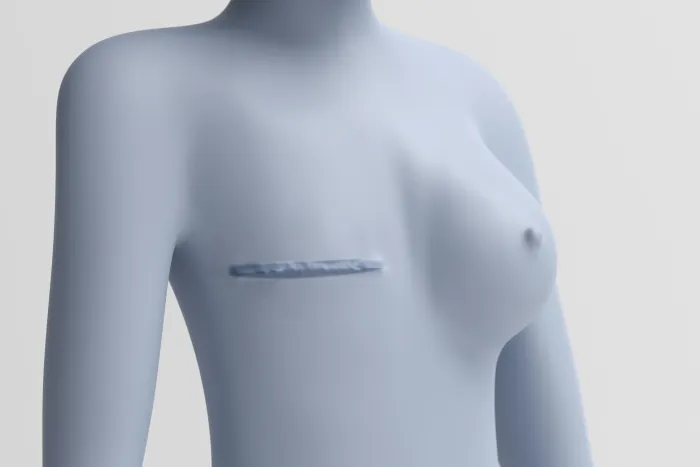 Implant Over Or Under Muscle After Mastectomy