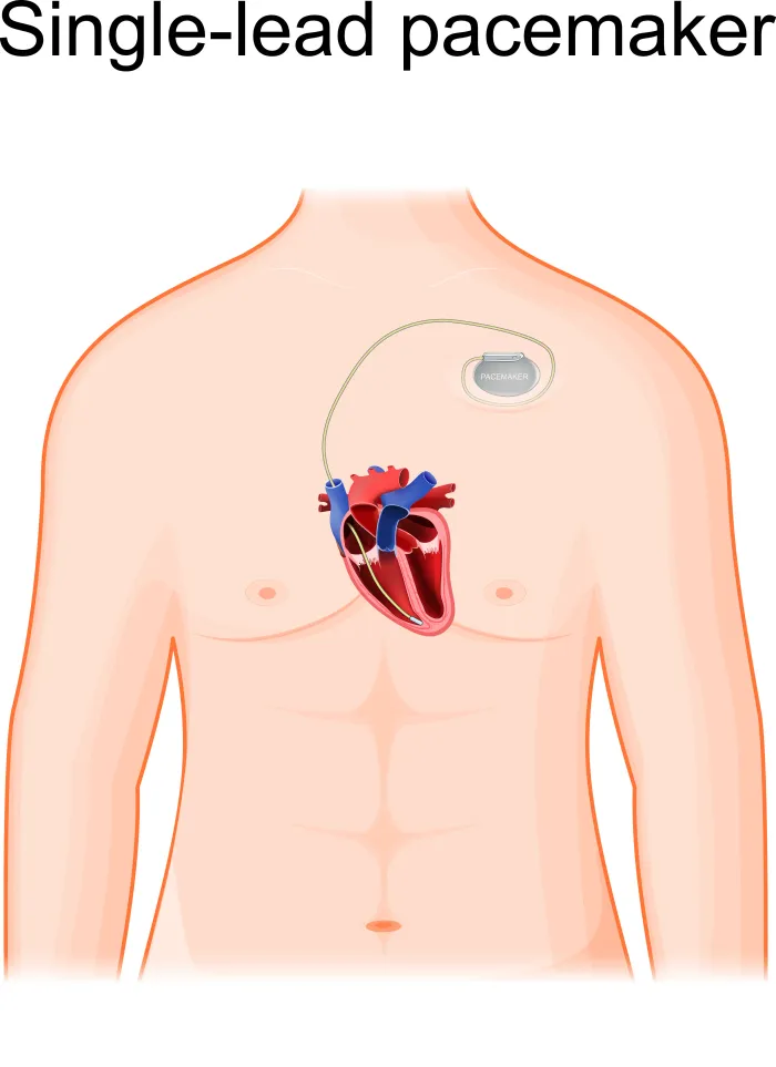 Understanding Pacemaker Complications: What You Need to Know