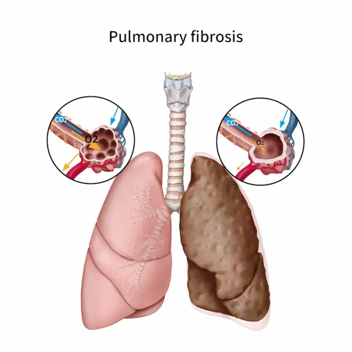 Pulmonary Fibrosis: Causes, Symptoms and Treatment