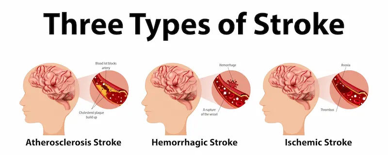 High Compression Stroke Neck Cracking and Stroke Risks: What You Should Know