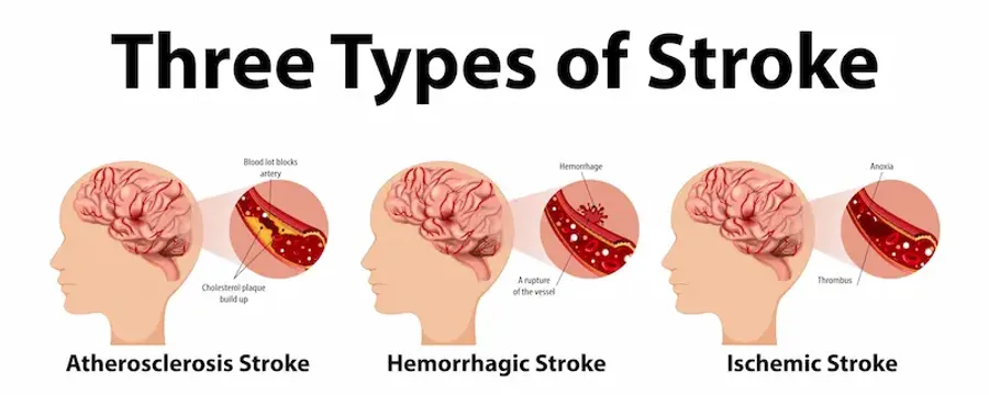 Stroke Types, Effects, and Recovery