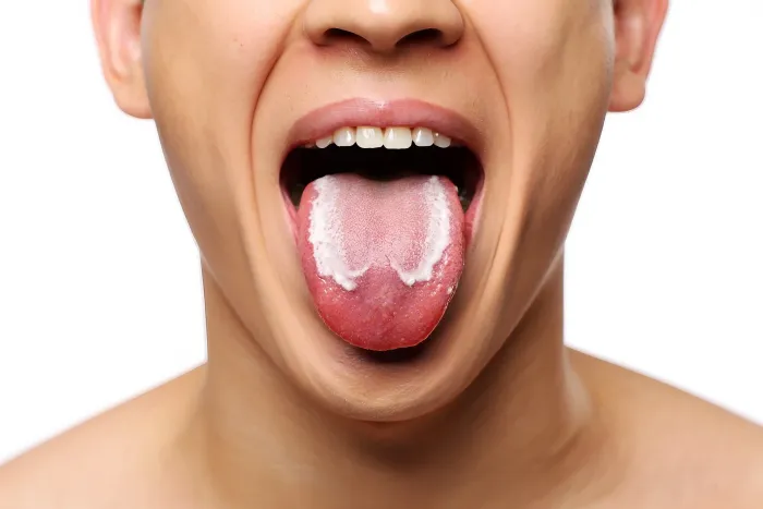 White Mouth Patches: Causes, Symptoms, and When to Seek a Check-Up