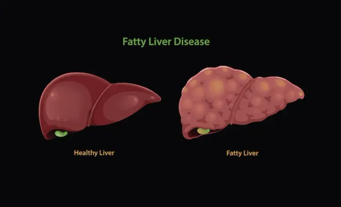 Fatty Liver Disease: Causes, Symptoms, Diagnosis, and Treatment