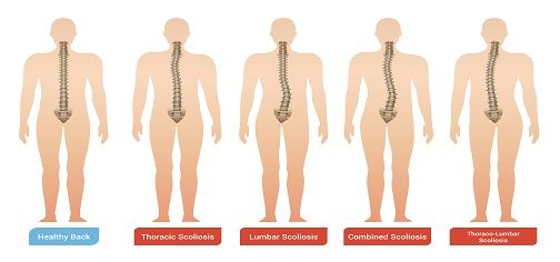 Facts about scoliosis