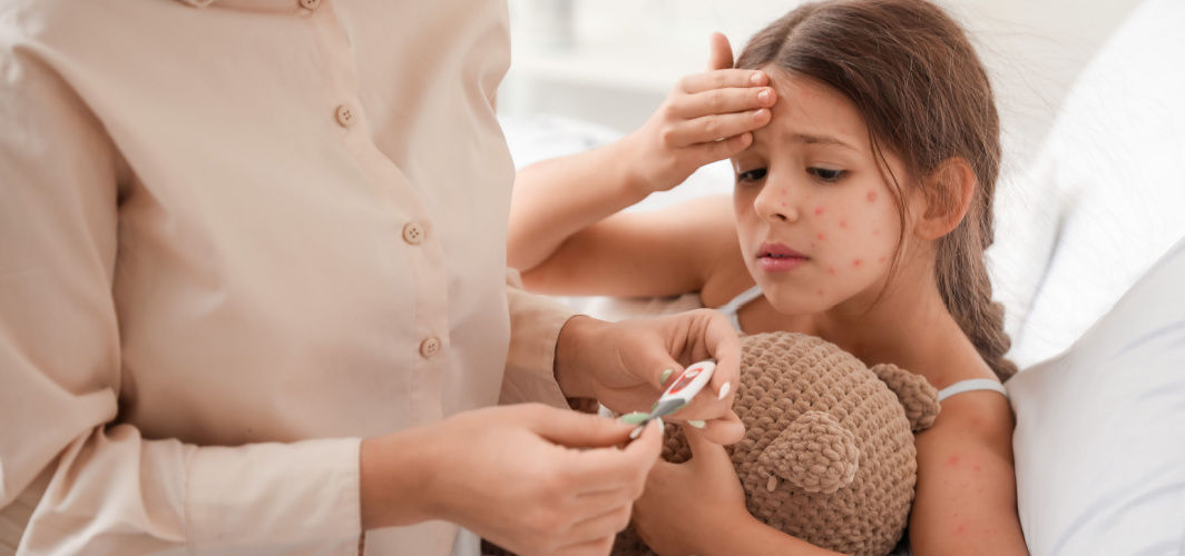 Chickenpox: Know The Treatment, Vaccine, & Complications