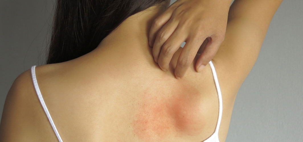How to Tackle Heat Rashes at Home?