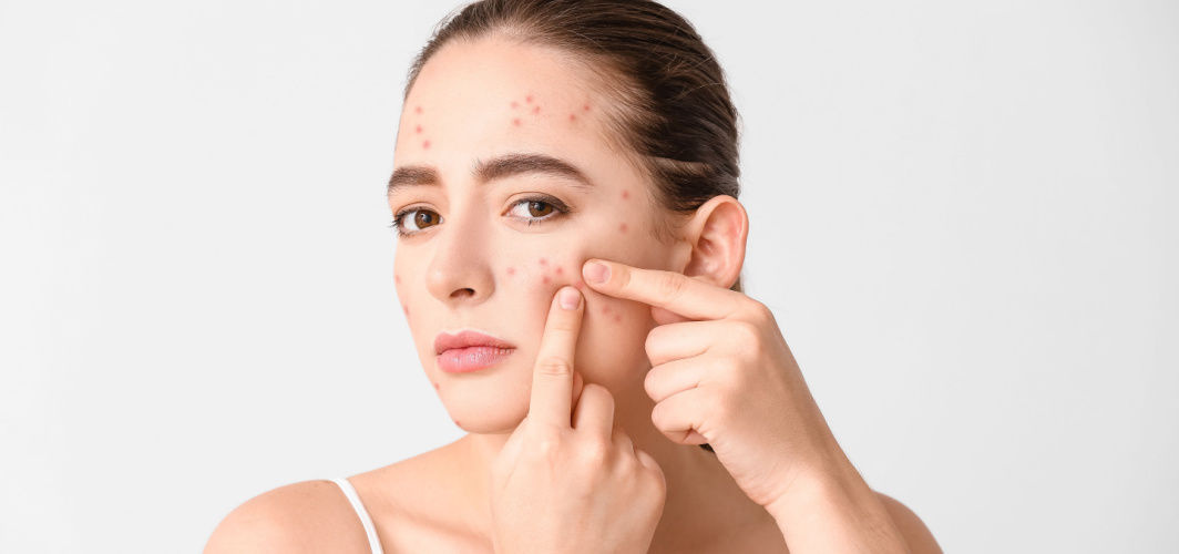 common reasons behind face pimples