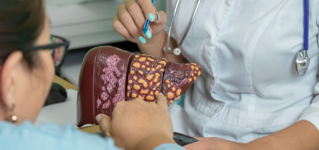 Cirrhosis Of Liver: Symptoms, Causes, Diagnosis, Treatment, Prevention