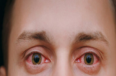 conjunctivitis