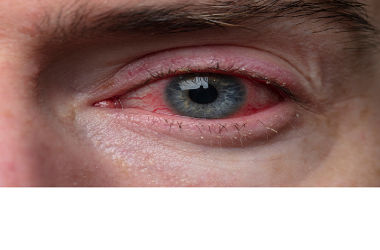 conjunctivitis