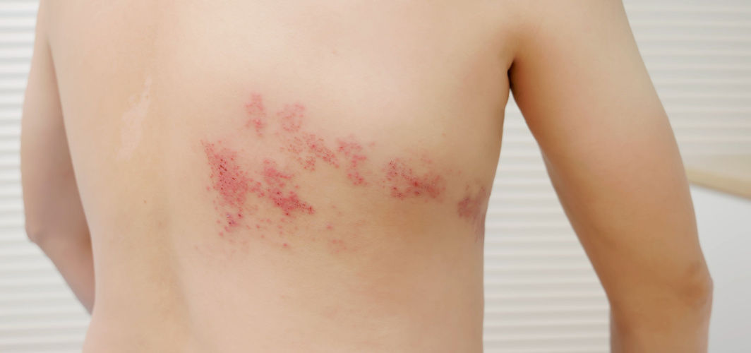 Shingrix: Your Guide to the Shingles Vaccine