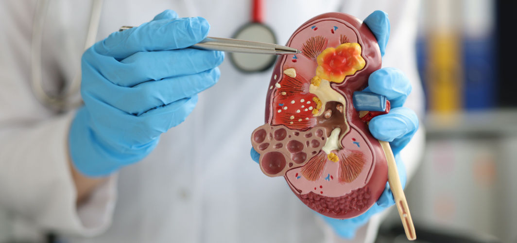 Kidney Failure: Symptoms, Cause, Diagnosis, Treatment, Prevention