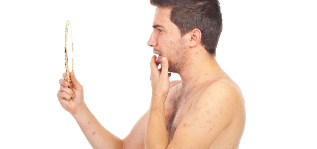 Chickenpox in Adults: Symptoms, Treatment and Vaccination